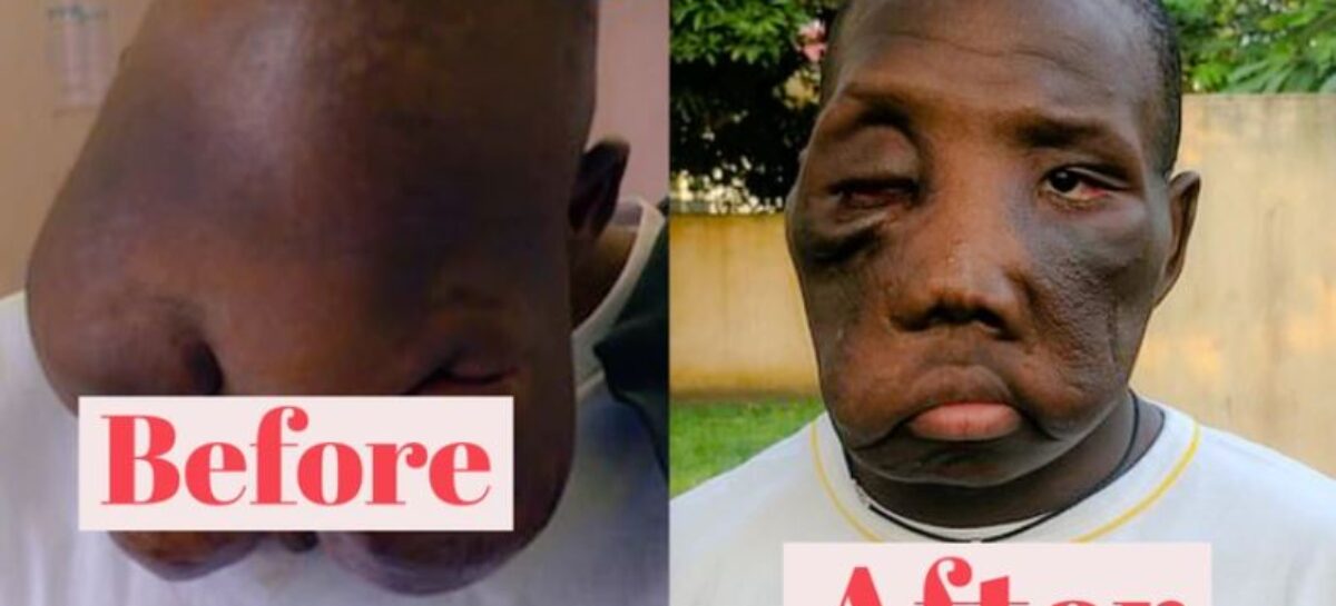 How Reconstruction Surgery Helped Transform The Appearance Of A Boy Who Was Rejected By His Mother