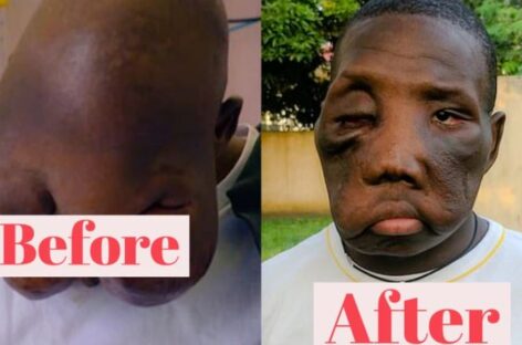 How Reconstruction Surgery Helped Transform The Appearance Of A Boy Who Was Rejected By His Mother