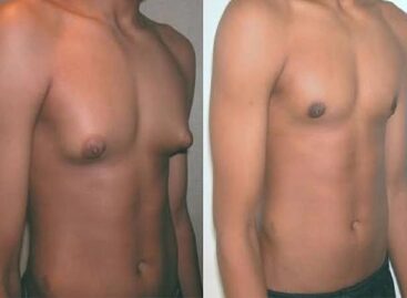 4 Reasons Why Some Men Have Swollen Breasts