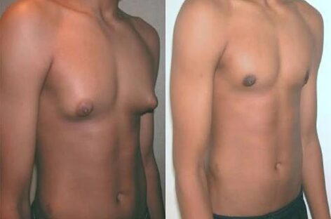 4 Reasons Why Some Men Have Swollen Breasts