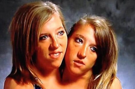 How Abigail And Brittany Share One Body And Have Been Living Life Like Normal People